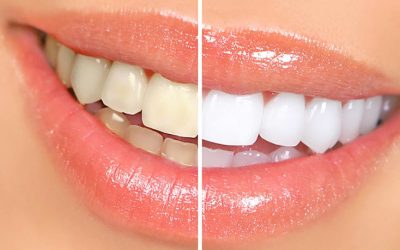 Teeth Whitening: Is It Safe?