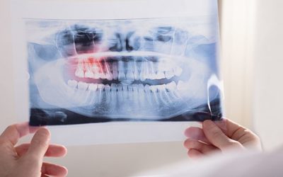 The Importance of Dental X-Rays
