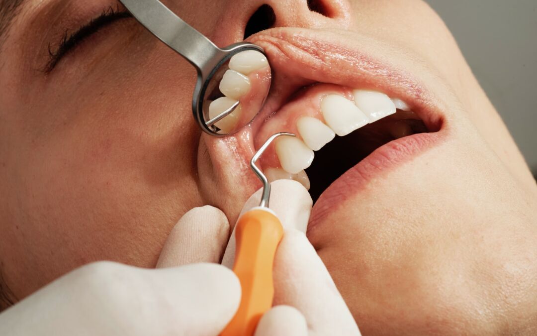 Wisdom Tooth Removal: Be Ready for Tooth Extraction Aftercare