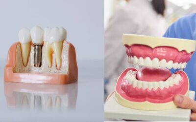 Dental Implants vs. Dentures: Which Is Right for You?