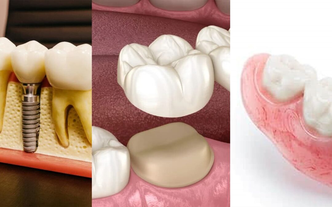 Tooth Replacement Options for Seniors: Bridges, Implants, and Dentures