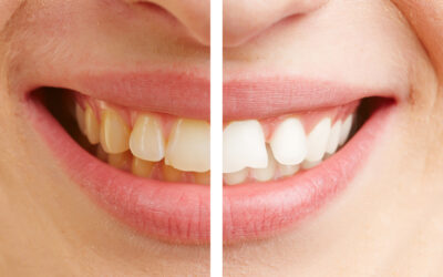 Winter vs. Summer Whitening: Why December Is a Great Time to Brighten Your Smile