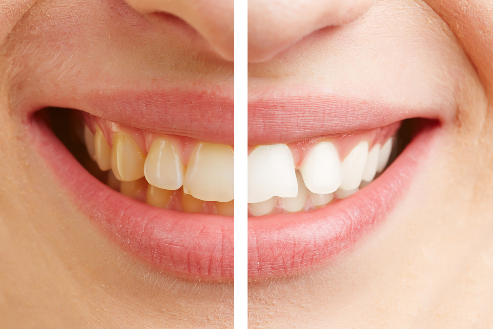 Winter vs. Summer Whitening: Why December Is a Great Time to Brighten Your Smile