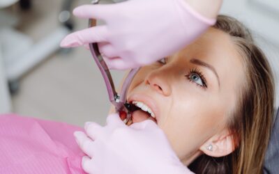Why Summer Break Is the Most Popular Time for Wisdom Teeth Extraction?